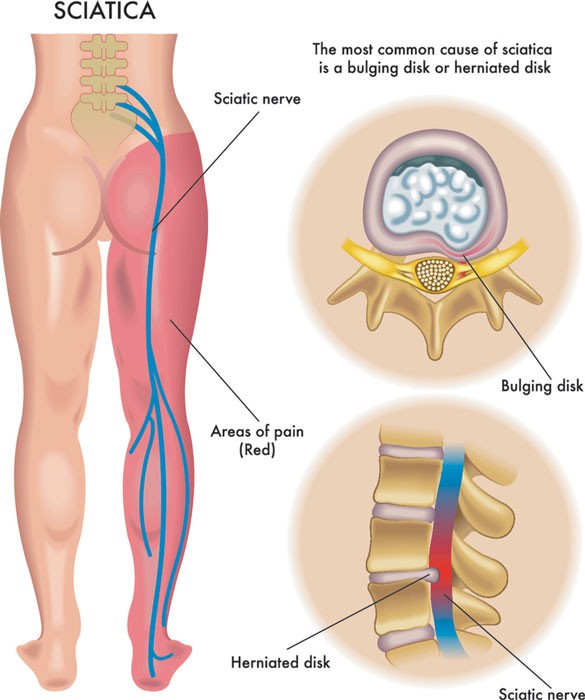 picture of sciatica nerve and pain referral sites on right leg