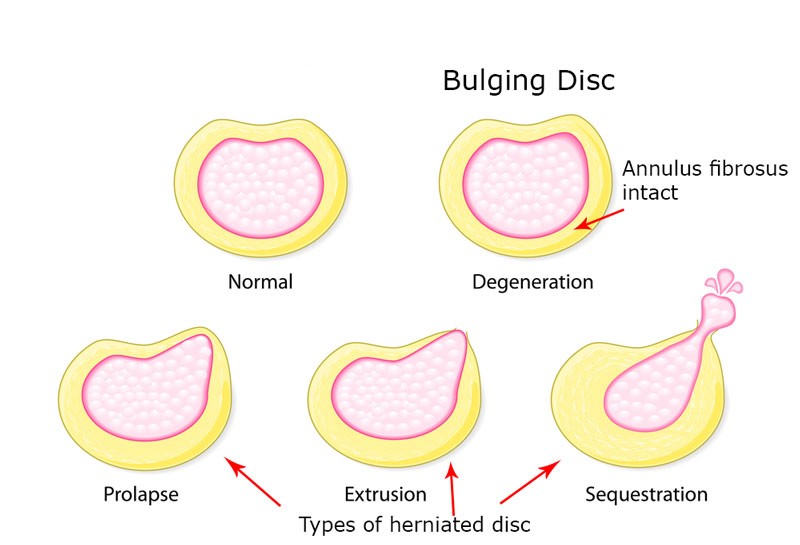 bulging disc and herniated disk types picture