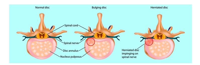 picture of normal disc, bulging disc and herniated disc