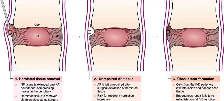 picture of herniated disc operation and risk of further disc herniation