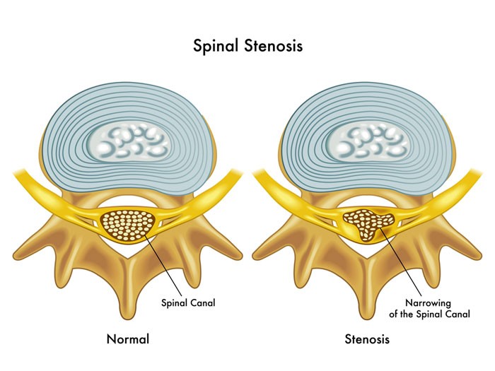 image of spinal stenosis and it's effect on sciatica nerve pain