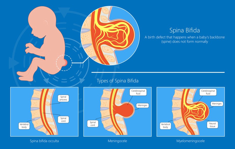 spina bifida explainer diagram and risk for chronic lower back pain