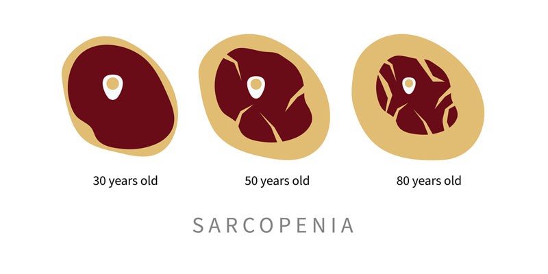 diagram showing sarcopenia and the risk of chronic lower back pain
