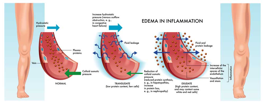 image of legf swollen up edema and cryotherapy