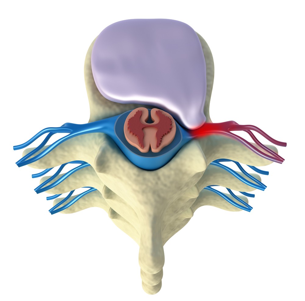 picture of herniated disc in the lumbar region of the spine